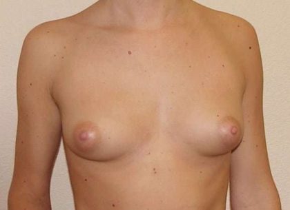 Breast Augmentation Before & After Patient #777