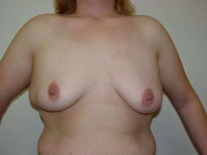 Breast Augmentation Before & After Patient #785