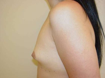 Breast Augmentation Before & After Patient #788