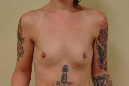 Breast Augmentation Before & After Patient #805