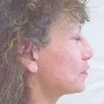 Rhinoplasty Before & After Patient #185