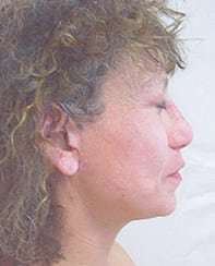 Rhinoplasty Before & After Patient #185