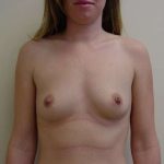 Breast Augmentation Before & After Patient #815