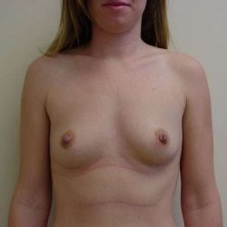 Breast Augmentation Before & After Patient #815