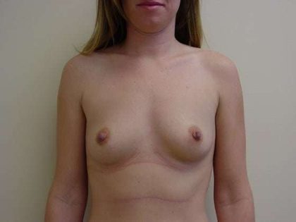 Breast Augmentation Before & After Patient #815