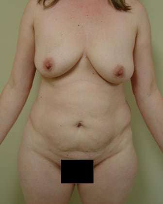 Tummy Tuck Before & After Patient #834