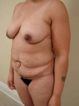 Tummy Tuck Before & After Patient #840
