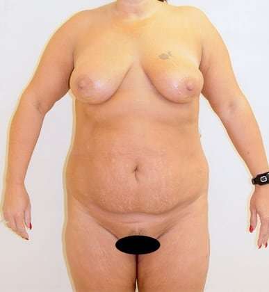 Tummy Tuck Before & After Patient #843
