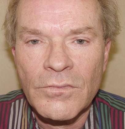 Laser Resurfacing Before & After Patient #128