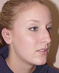 Rhinoplasty Before & After Patient #188
