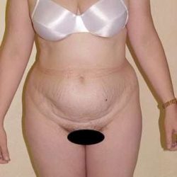 Tummy Tuck Before & After Patient #846