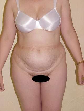 Tummy Tuck Before & After Patient #846