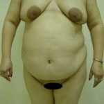 Tummy Tuck Before & After Patient #849