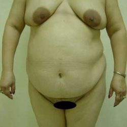 Tummy Tuck Before & After Patient #849