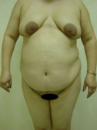 Tummy Tuck Before & After Patient #849