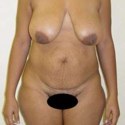 Tummy Tuck Before & After Patient #863