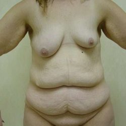 Tummy Tuck Before & After Patient #875