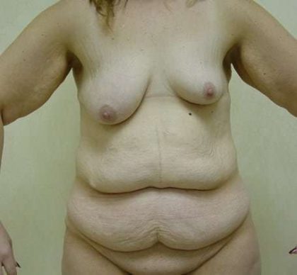 Tummy Tuck Before & After Patient #875