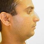 Rhinoplasty Before & After Patient #191