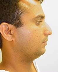 Rhinoplasty Before & After Patient #191