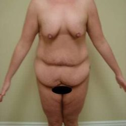 Tummy Tuck Before & After Patient #882