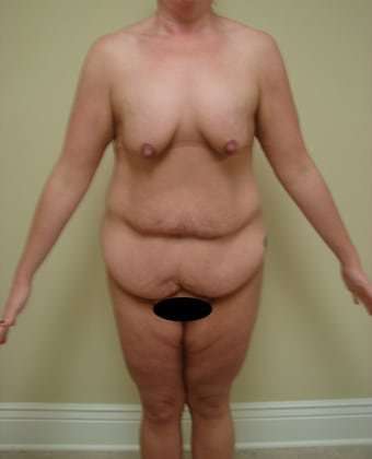 Tummy Tuck Before & After Patient #882