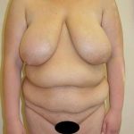 Tummy Tuck Before & After Patient #891