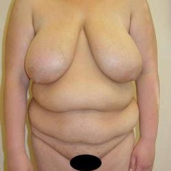 Tummy Tuck Before & After Patient #891