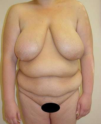 Tummy Tuck Before & After Patient #891