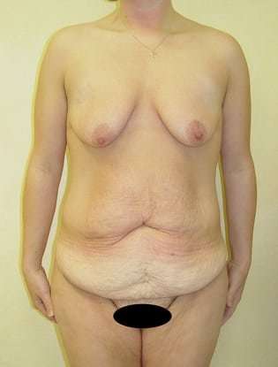 Tummy Tuck Before & After Patient #899