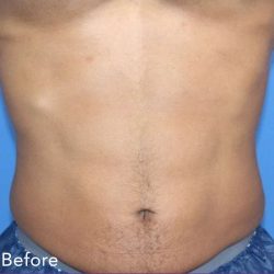 truSculpt® Before & After Patient #915