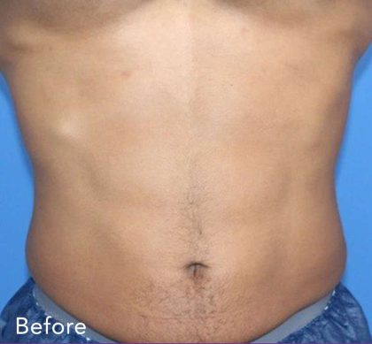 truSculpt&reg; Before & After Patient #915