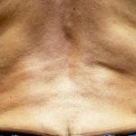 truSculpt® Before & After Patient #919