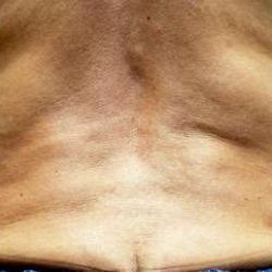 truSculpt® Before & After Patient #919