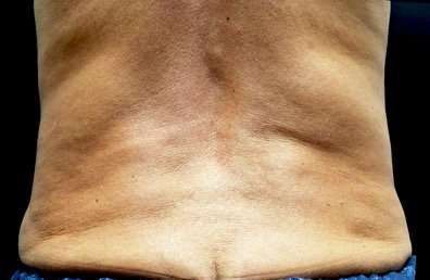truSculpt&reg; Before & After Patient #919