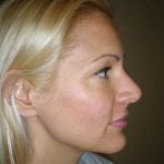 Rhinoplasty Before & After Patient #194