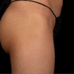 truSculpt® Before & After Patient #922