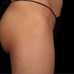 truSculpt® Before & After Patient #922