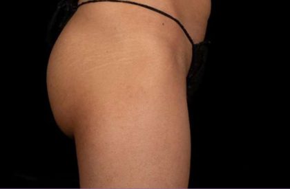 truSculpt&reg; Before & After Patient #922