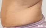 truSculpt® Before & After Patient #925