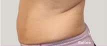 truSculpt® Before & After Patient #925