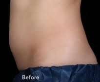 truSculpt® Before & After Patient #930