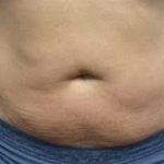 truSculpt® Before & After Patient #933