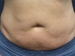 truSculpt® Before & After Patient #933