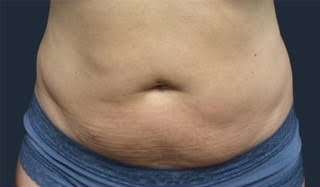 truSculpt® Before & After Patient #933