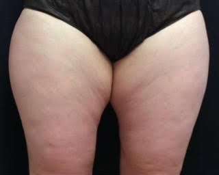 truSculpt® Before & After Patient #936
