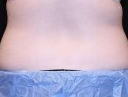 truSculpt® Before & After Patient #943