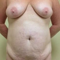 Mommy Makeover Before & After Patient #956