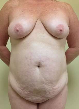 Mommy Makeover Before & After Patient #956