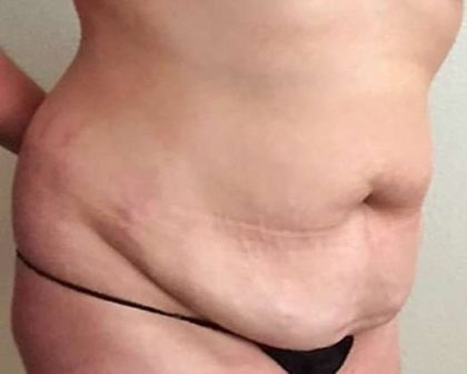 Mommy Makeover Before & After Patient #959